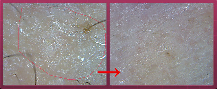 男生脸上很多处脱皮怎么办,男生脸上脱皮干燥