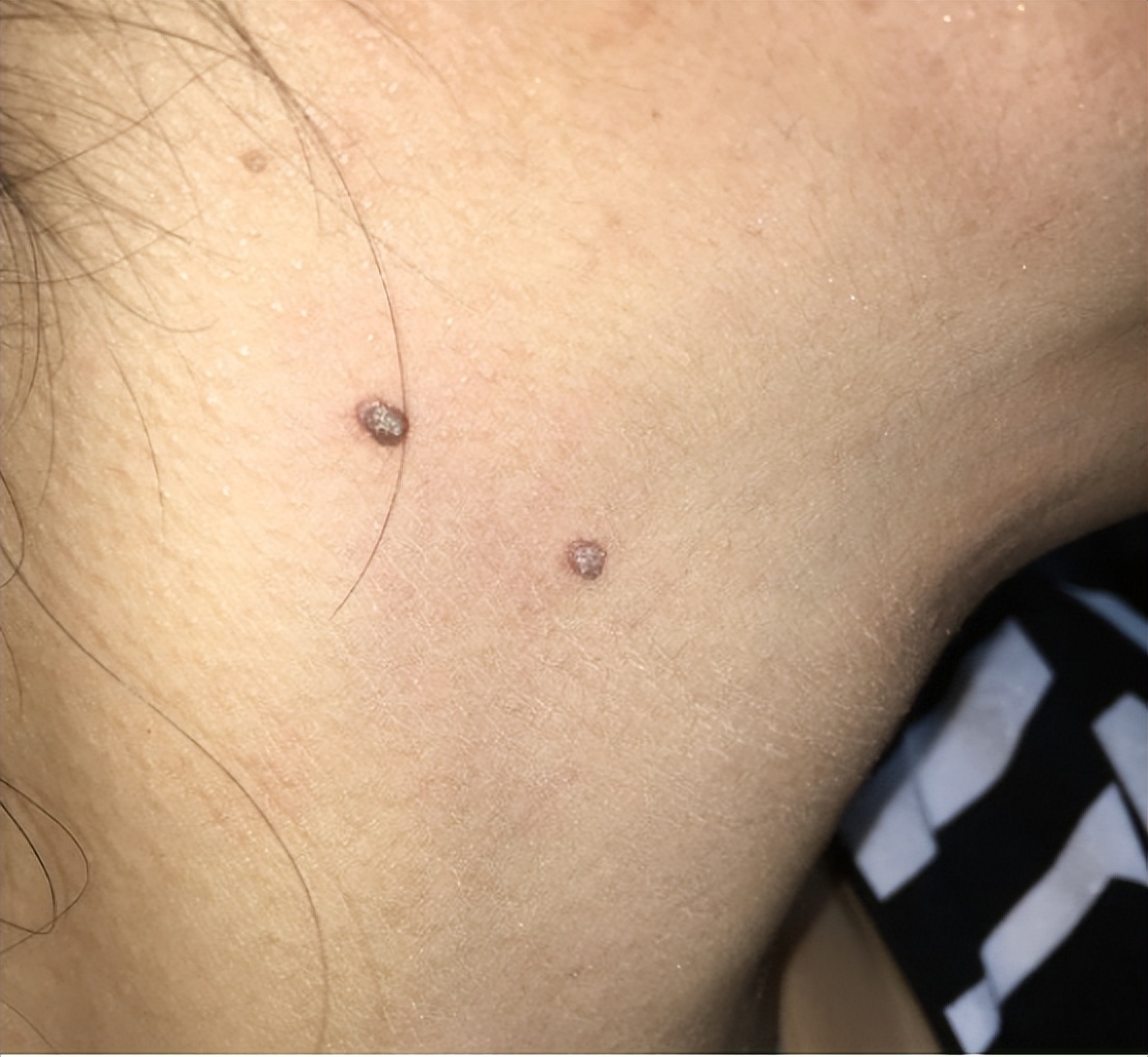 脖子上长小肉疙瘩丝状疣怎么治疗,脖子上长小肉疣怎么治疗