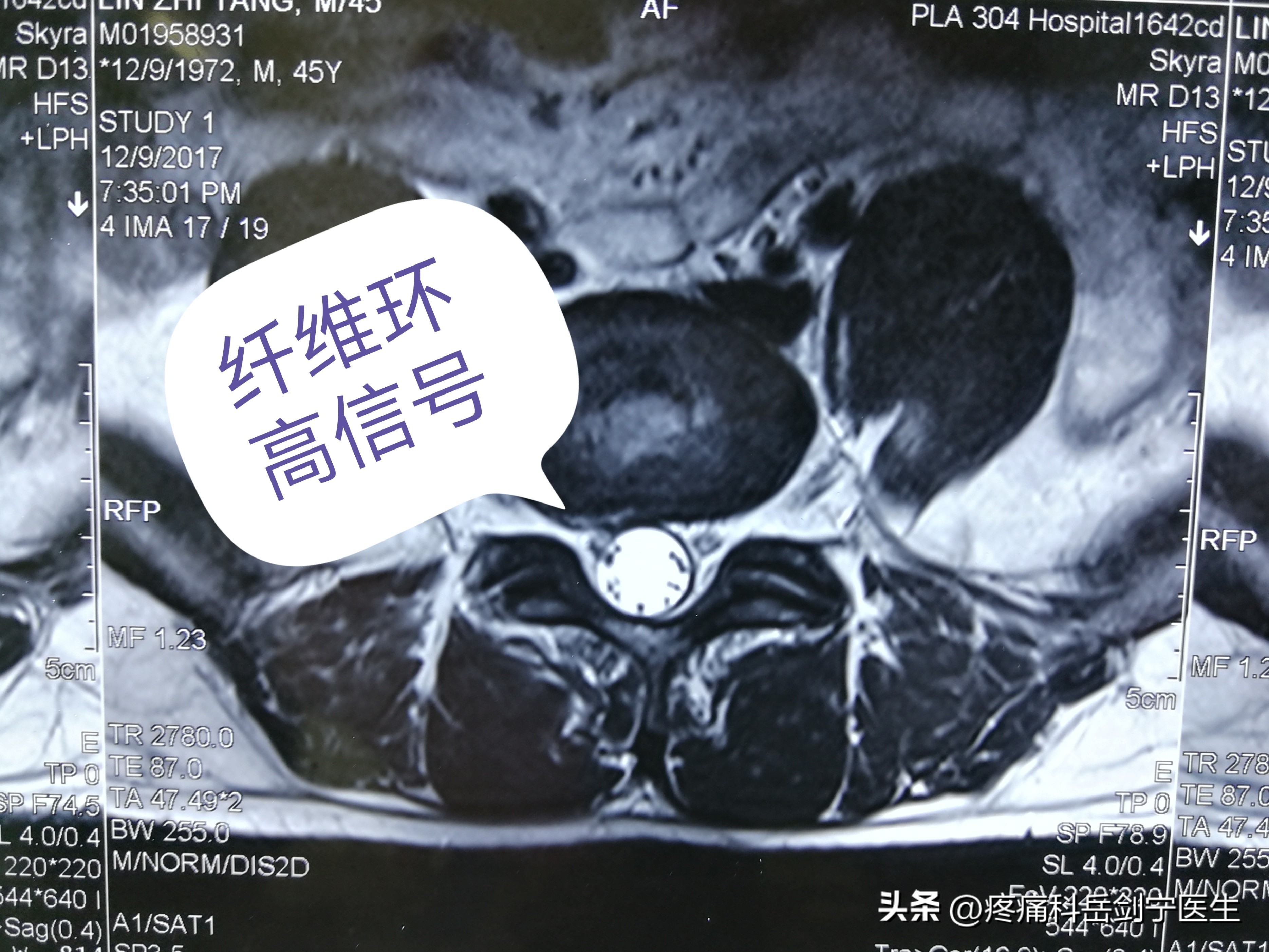 椎间盘引起的腰痛一般多久消失,腰痛查不出结石
