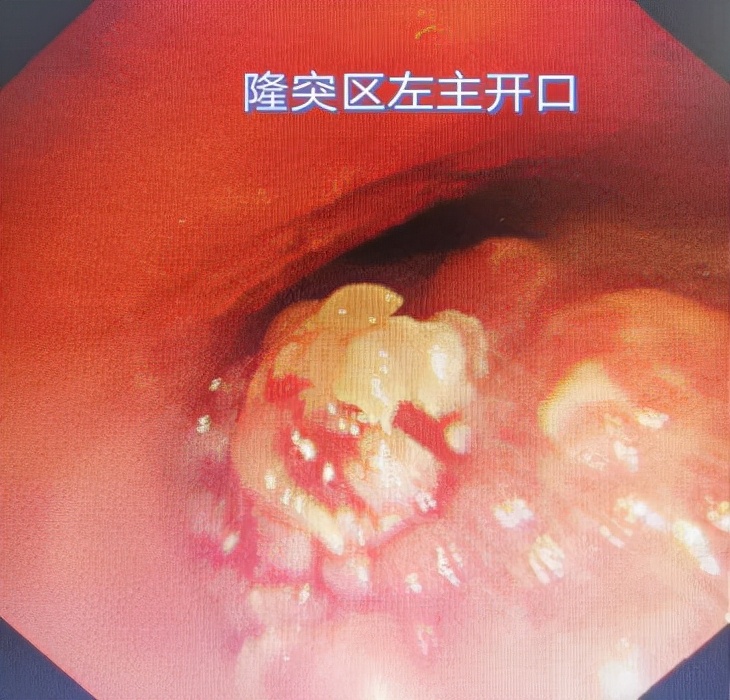 哈医大一院气管镜,哈医大群力呼吸内科