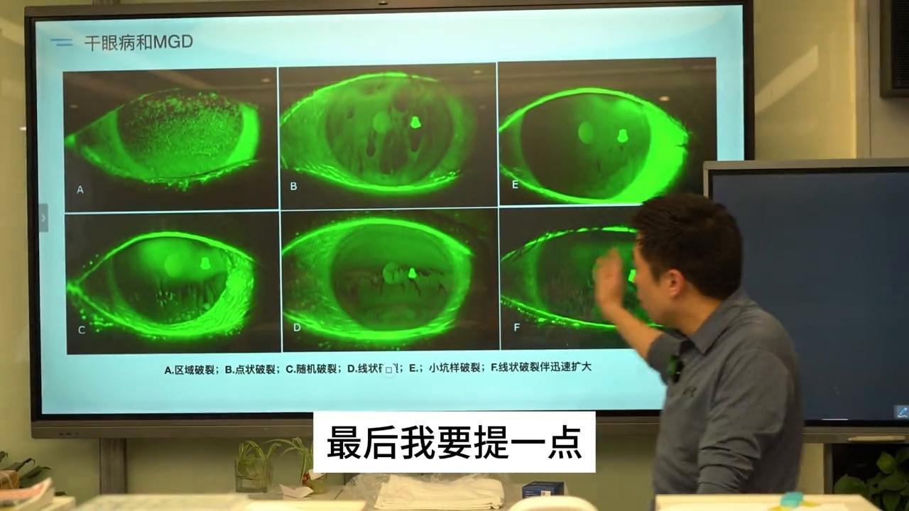 干眼症张钦,张钦医生干眼症