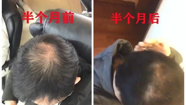 男子秃顶半月不用洗发水后长出头发网友：洗发水公司要破产了