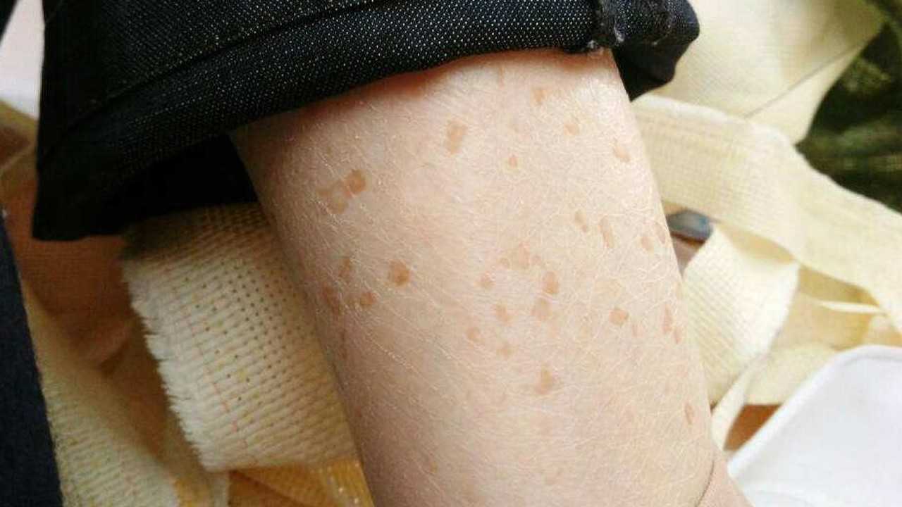 为什么说牙膏是老年斑的克星,牙膏祛老年斑最好的克星