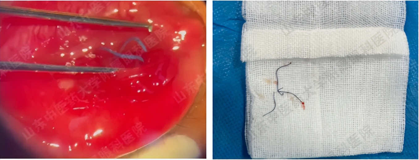 埋线双眼皮线头出来了严重吗,埋线双眼皮线头露在外边了怎么办