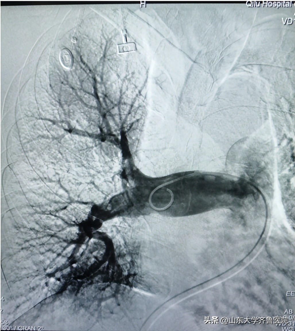 齐鲁医院首例,山东齐鲁医院血栓取栓术