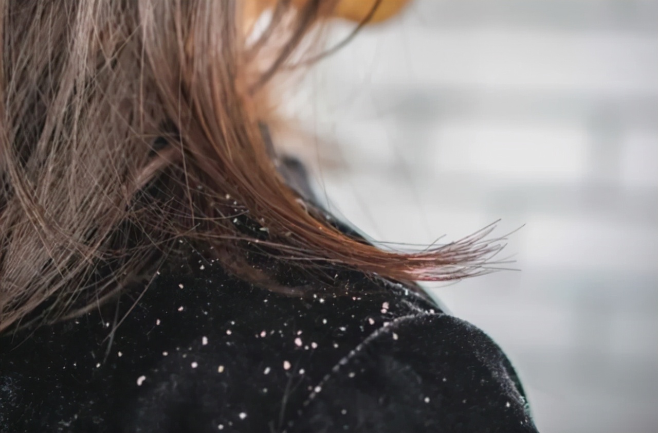 天天洗头有头皮屑怎么办,天天洗头也有头皮屑是什么原因