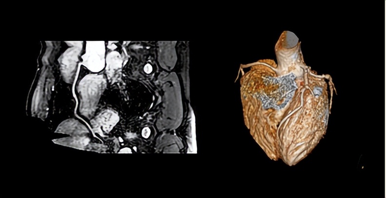 破冰者:飞利浦加速高端医学影像国产化