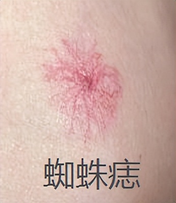 今年35岁发现皮肤长有小红痣,身上出现小红痣是不是皮肤老化了