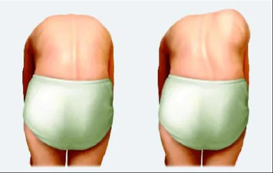 儿童骨头长歪了怎么办,身体长歪的孩子图片