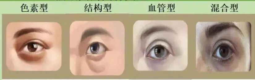 有效去黑眼圈和泪沟方法,黑眼圈泪沟抗衰老