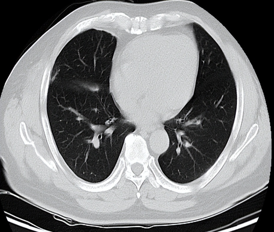 海南首例恶性胸膜间皮瘤,胸膜间皮瘤生存5年算治愈吗
