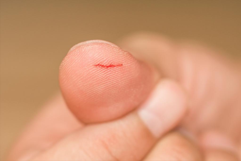 癌症的发病原因及其如何预防,癌症都是先由炎症引起的吗