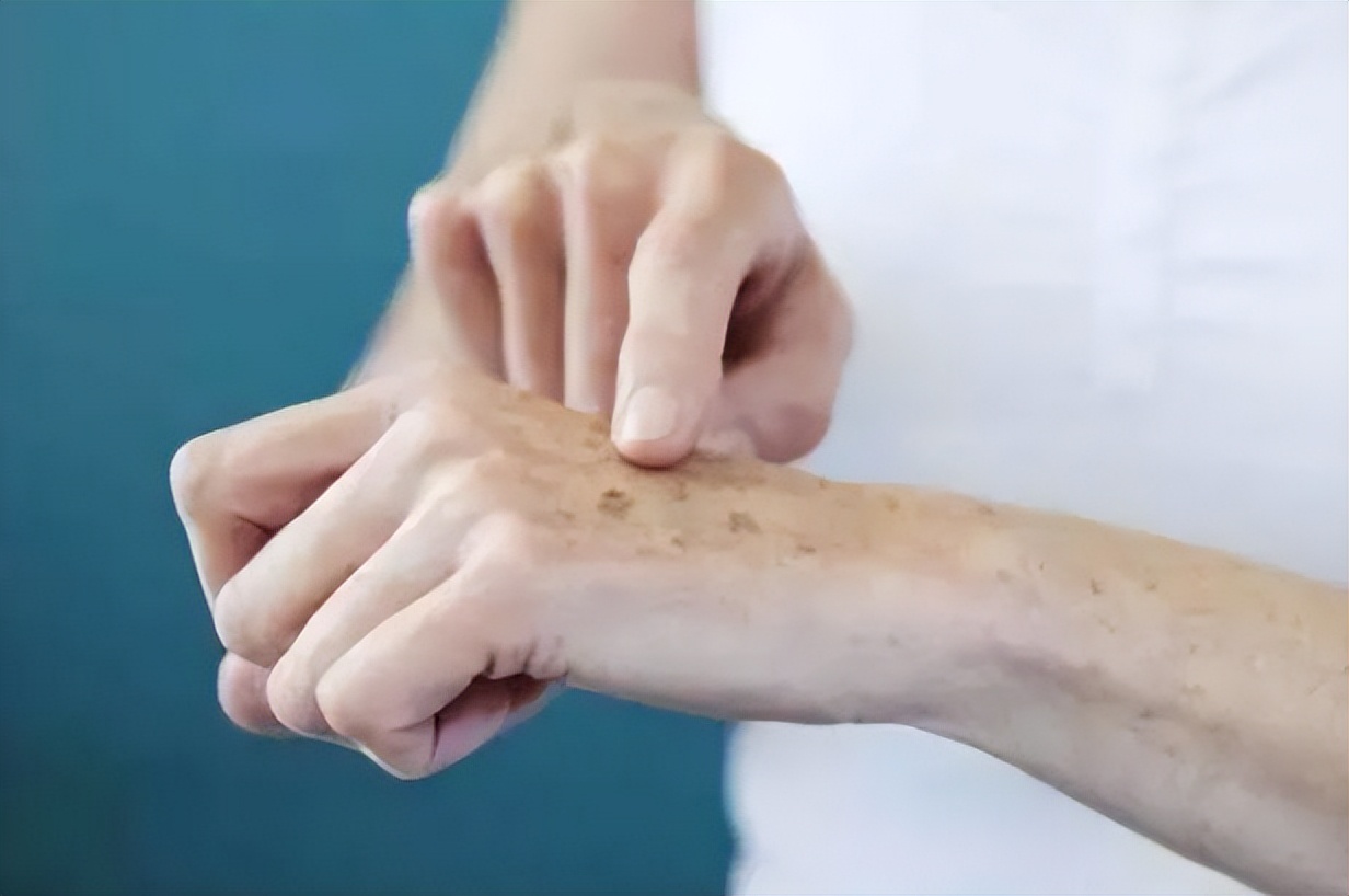 老人斑用红霉素软膏能消斑吗,红霉素软膏可以去除老年斑吗