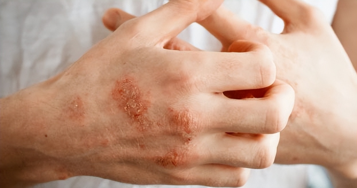 炉甘石洗剂的作用和功效价格,炉甘石洗剂的功效与作用和价格