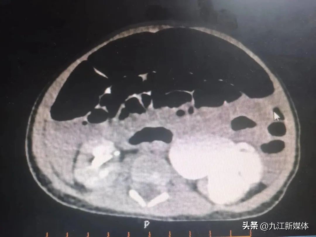 婴儿左肾重度积水怎么办,刚出生的婴儿肾积水22mm
