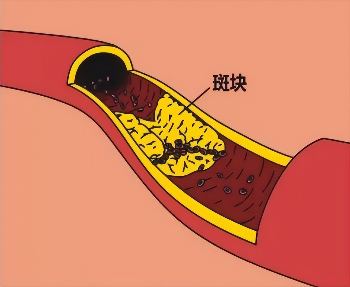 脑梗颈动脉斑块90%能治愈吗,有颈动脉斑块需要服他汀药吗