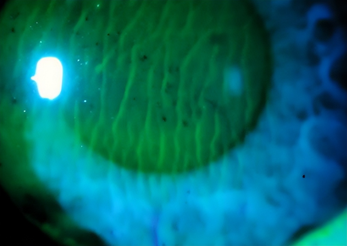 同济大学附属上海东方医院金海鹰教授：巩膜层间缝纫机技术要点