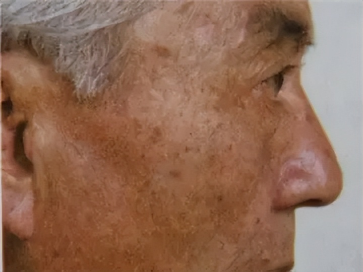 老年色素沉着斑怎么消除,色素沉着老年斑能去除吗