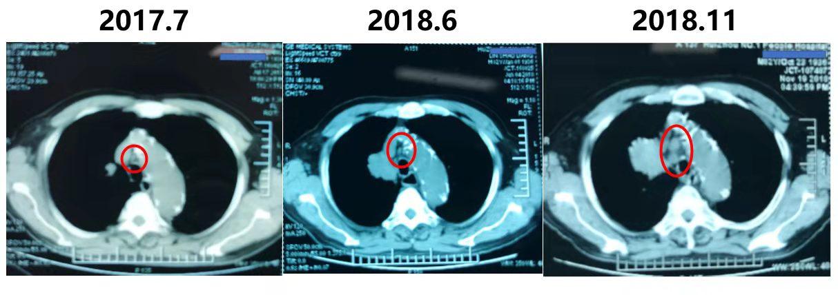 70岁肺癌晚期还需要做靶向治疗,70岁肺癌没扩散要不要手术