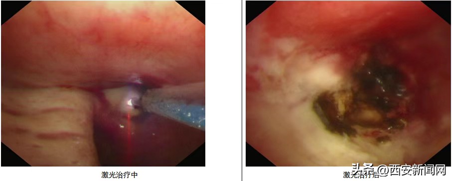 医院开展支气管镜下治疗,医院开展输尿管镜下钬激光碎石术
