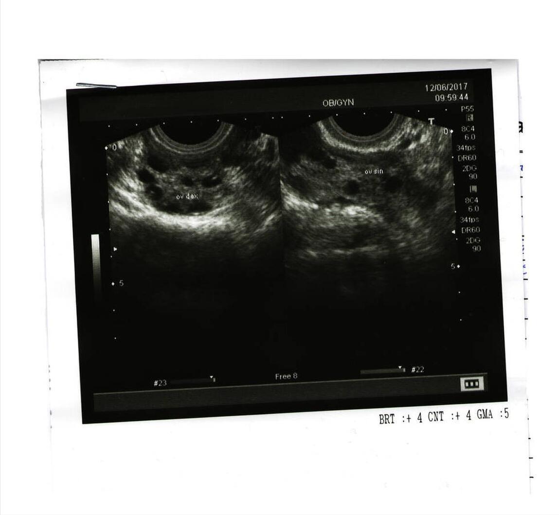 被气出来的卵巢囊肿,卵巢囊肿九厘米了