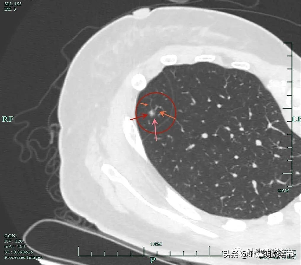 肺癌右中上叶全切,右肺上叶小结节查出是癌怎么办