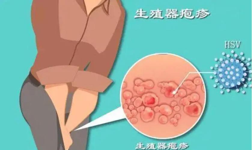 有哪些病可以通过性传播,八种性传播疾病有哪些