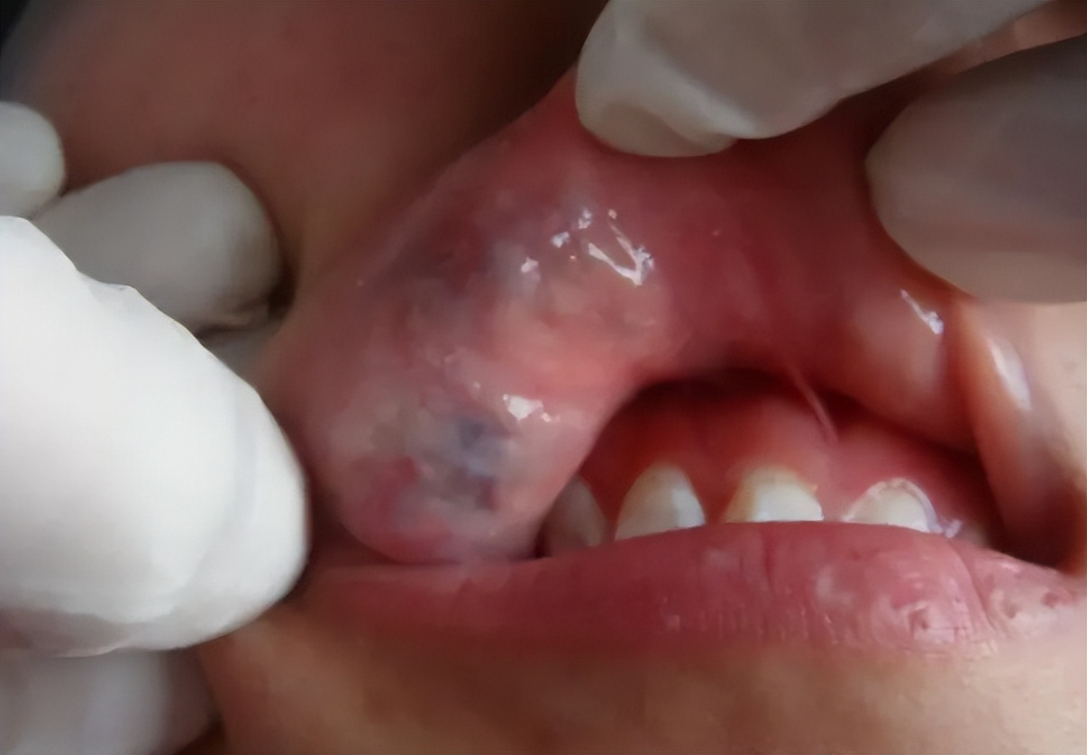 血管瘤的护理常识,宝宝血管瘤激光后要怎么护理