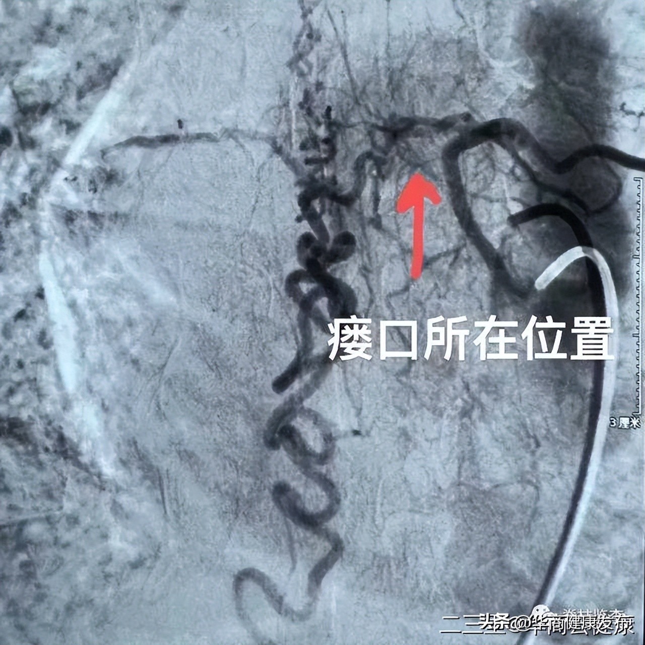 下肢无力一定是腰突引起的吗,腰椎硬脊膜瘘的症状和治疗