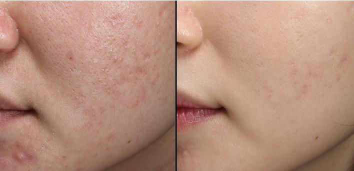 博乐达超分子水杨酸保湿霜,博乐达水杨酸洗面奶油皮痘肌