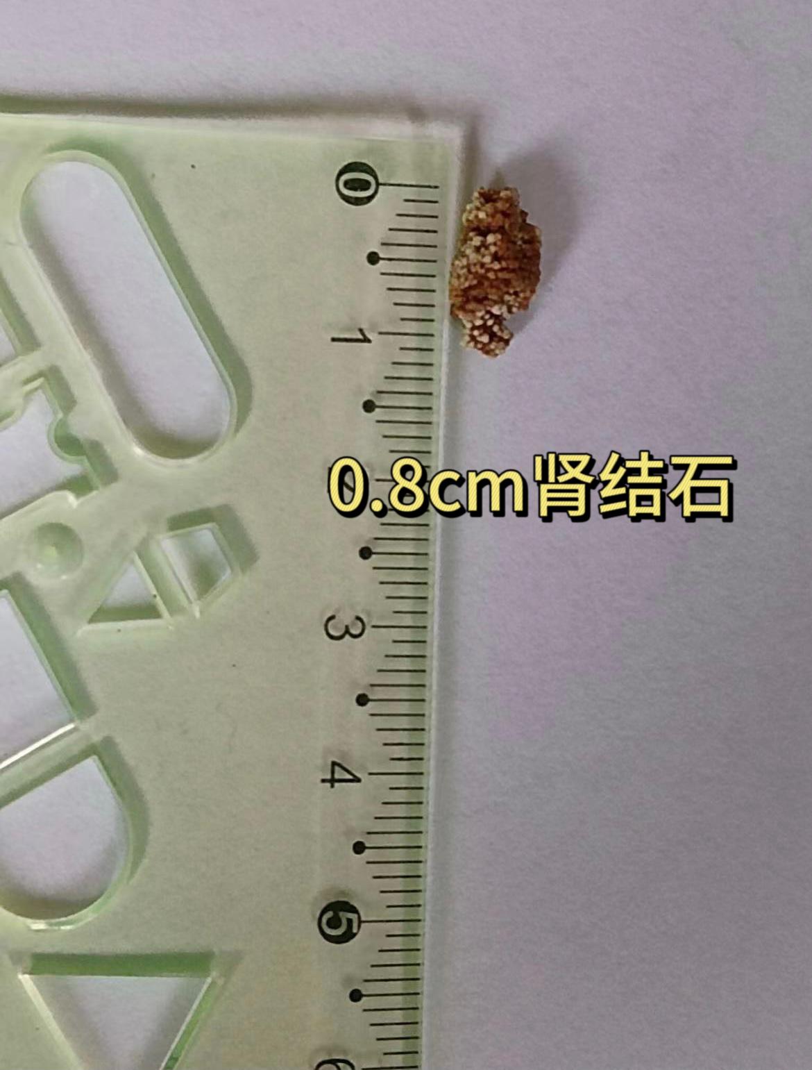 肾结石1.2厘米结石最快的排出方法,0.3-0.5的结石有多大图片