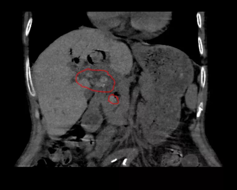 微创跟单孔腹腔镜的区别,微创腹腔镜单孔取胆结石