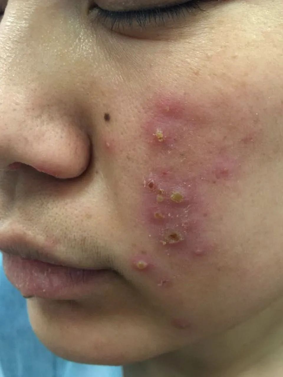 注射完后针眼溃烂怎么办,注射后针孔发炎怎么处理