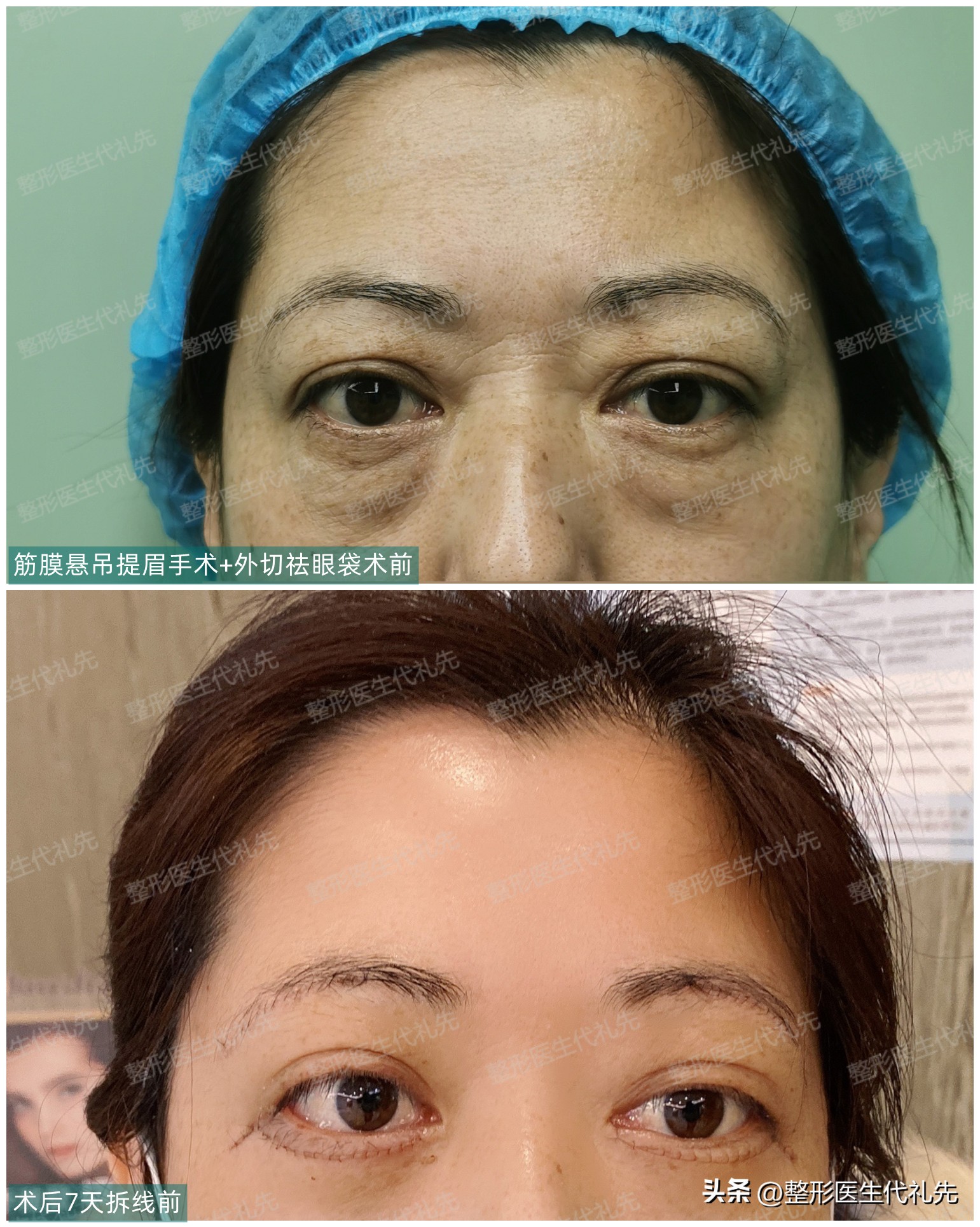 内切祛眼袋手术亲身经历恢复,作为一名整形医生对整形的理解