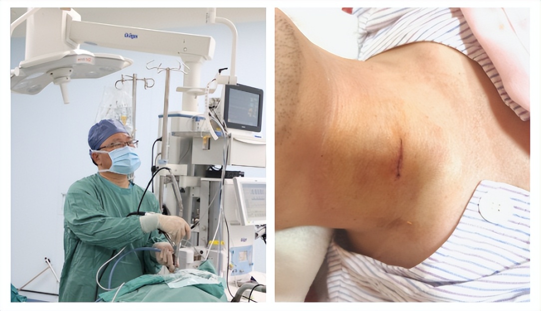 颈椎后路内镜微创手术,颈椎韧带钙化手术切除全过程