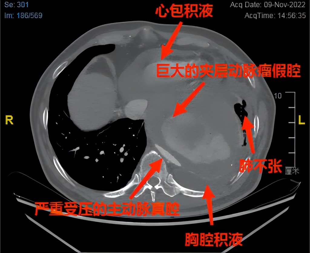 南昌大学二附院脑动脉瘤,南昌大学二附院血管介入科