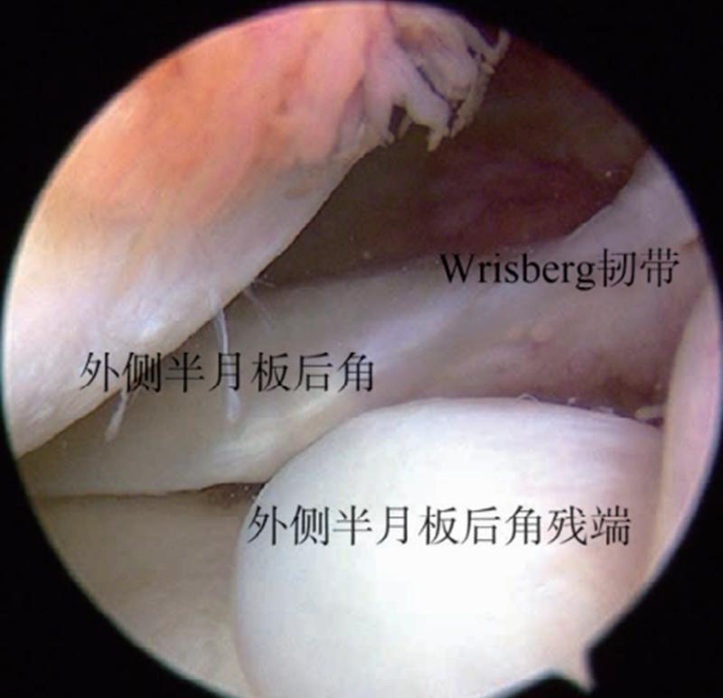 膝关节前交叉韧带损伤怎么治,十字交叉韧带损伤如何解决