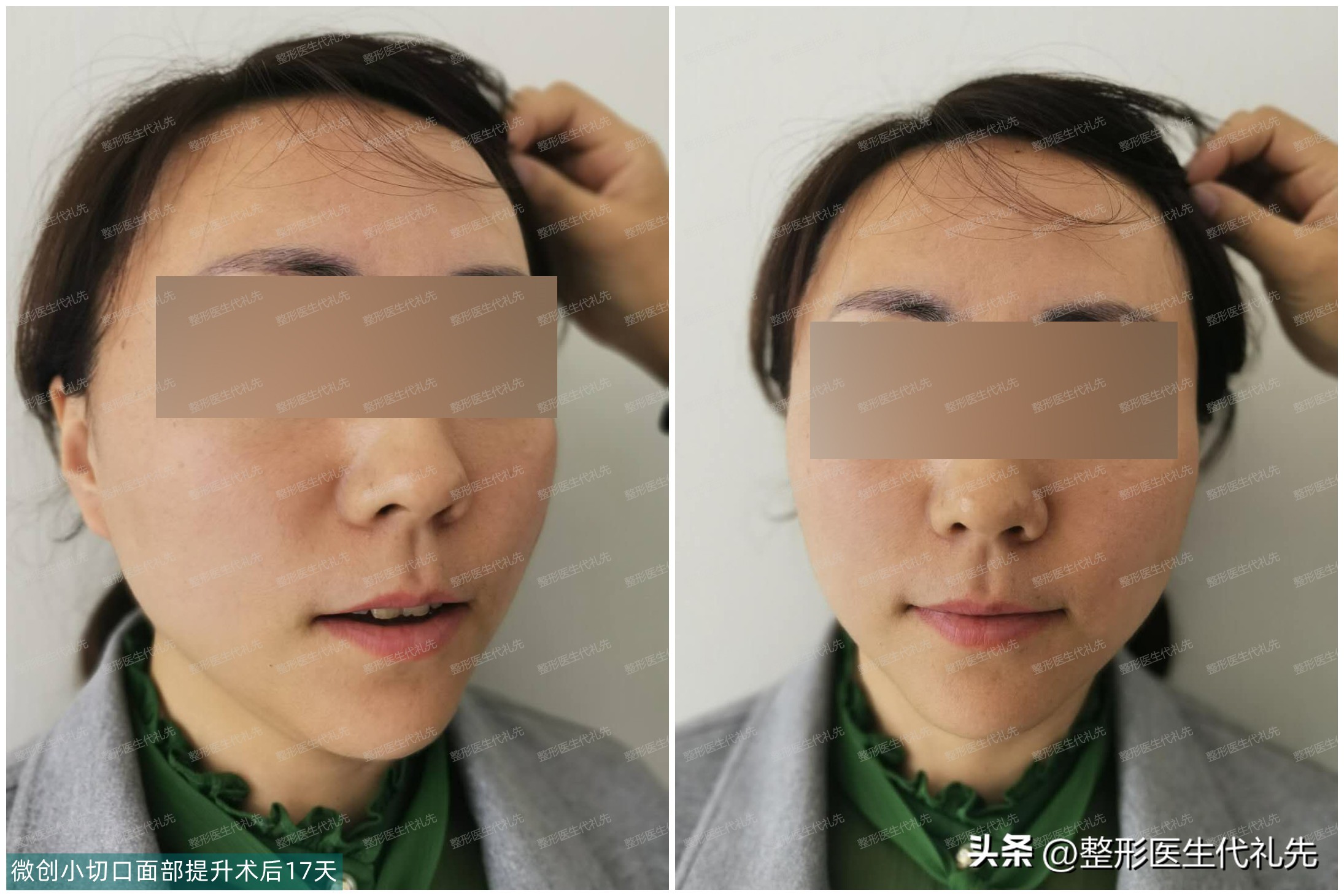 40岁下颌缘提升还有用吗,下颌线提升后怎么脸变方了