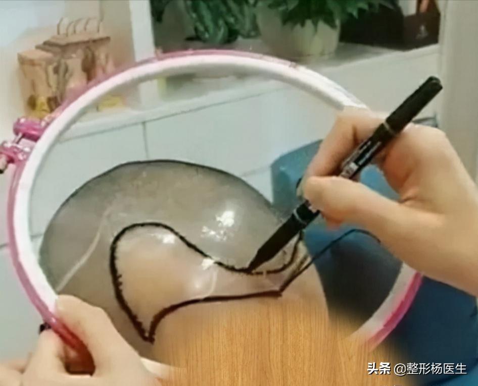 微针植发的优点和缺点,微针植发哪家靠谱