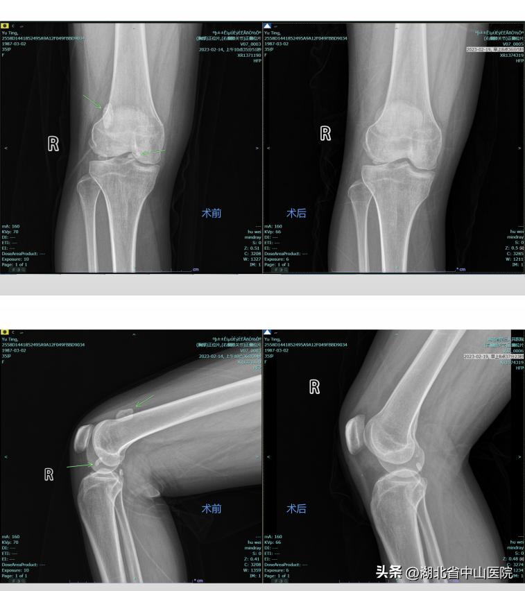 【中山医“声”】膝盖“卡壳”是怎么回事？原来是游离体在捣乱