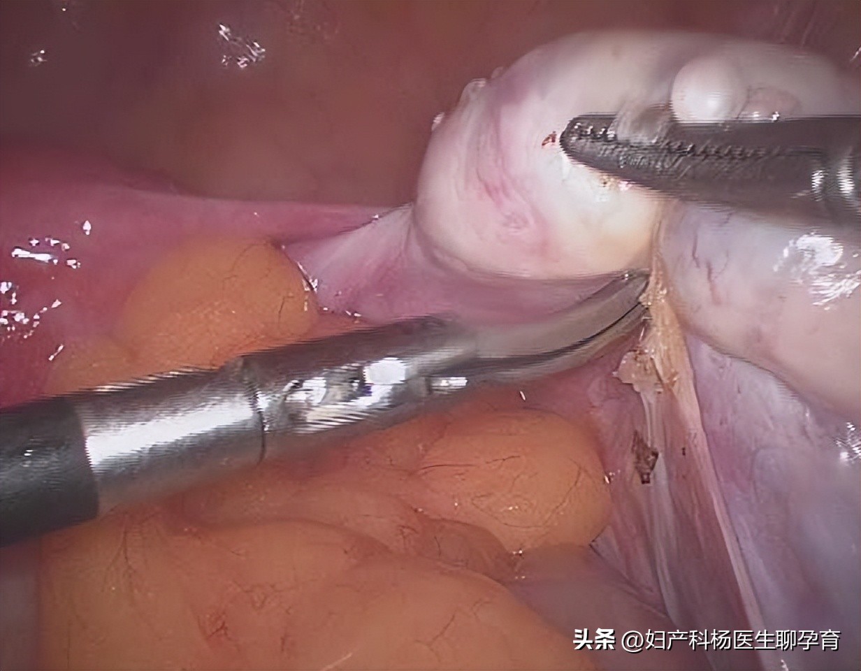 宫颈口松弛导致宫颈妊娠的几率,宫颈松弛有可能恢复吗