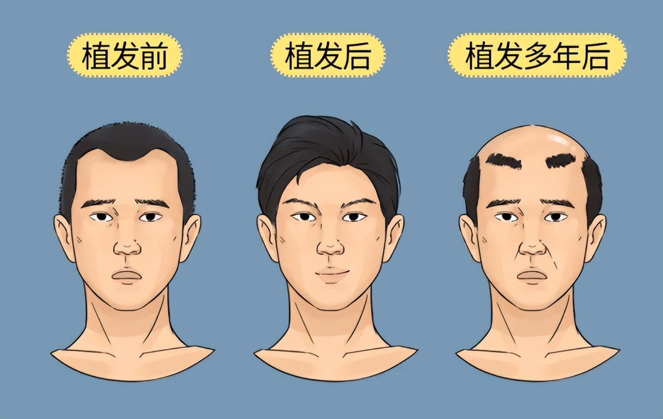 脱发严重要不要植发？有没有更好的治疗方法？