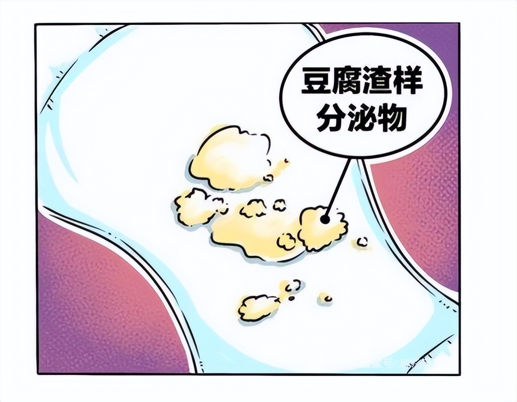 豆腐渣样分泌物伴有瘙痒用什么药,分泌物像豆腐渣还瘙痒可以治好吗