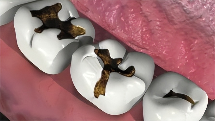 蛀牙有什么注意事项,蛀牙龋坏怎么预防