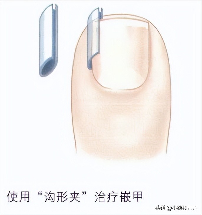 得了甲沟炎该怎么办？千万别急着拔甲