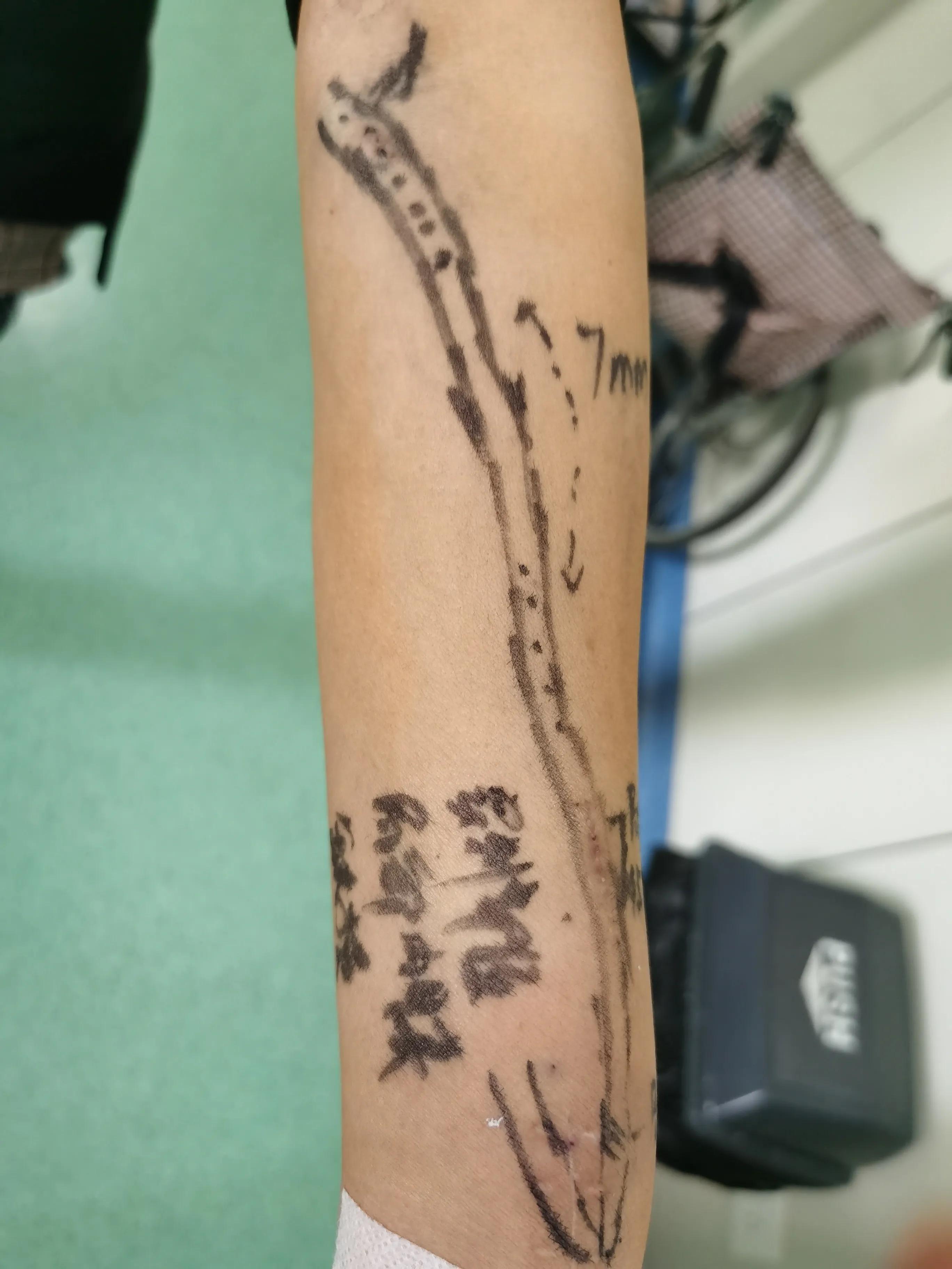 血管通路维护的意义,血管通路护理是怎样工作的