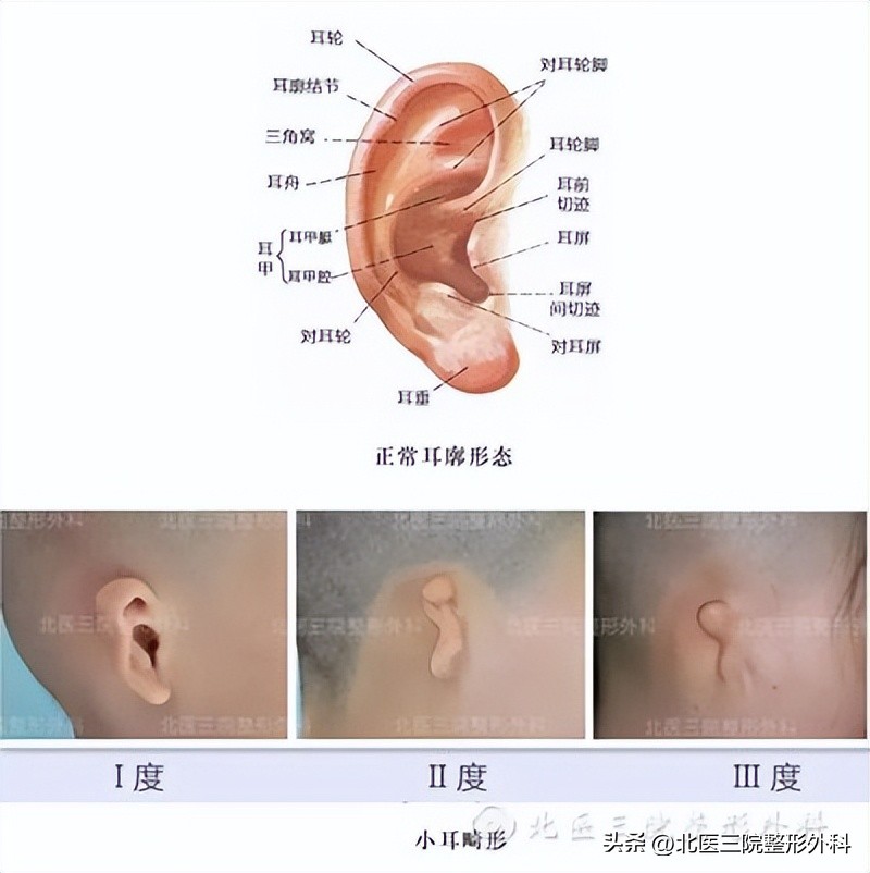 耳廓再造的三个方法,双侧无优势会影响移植吗