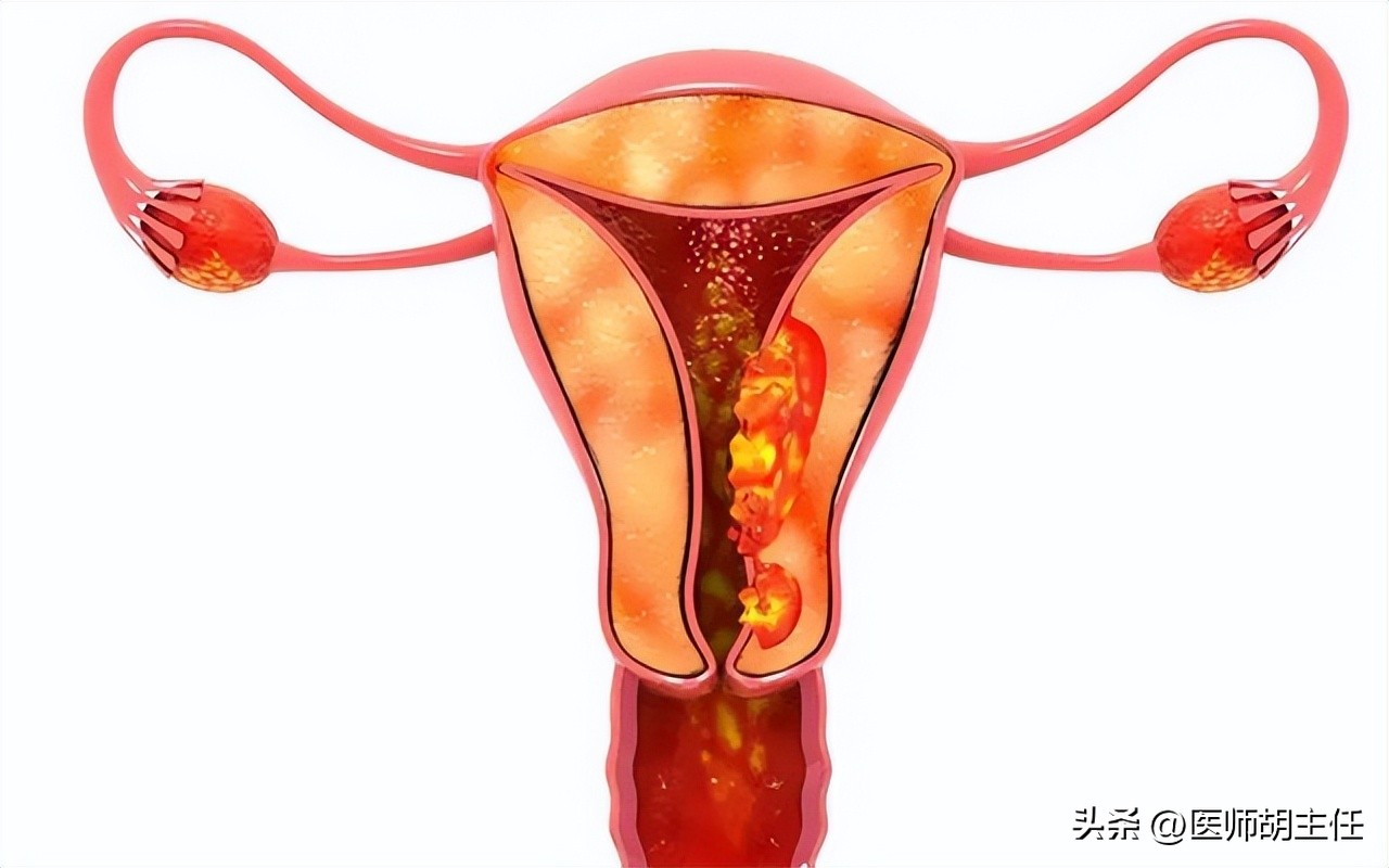 宫颈癌的前兆会不会腿痛,宫颈癌有一项异常会怎样