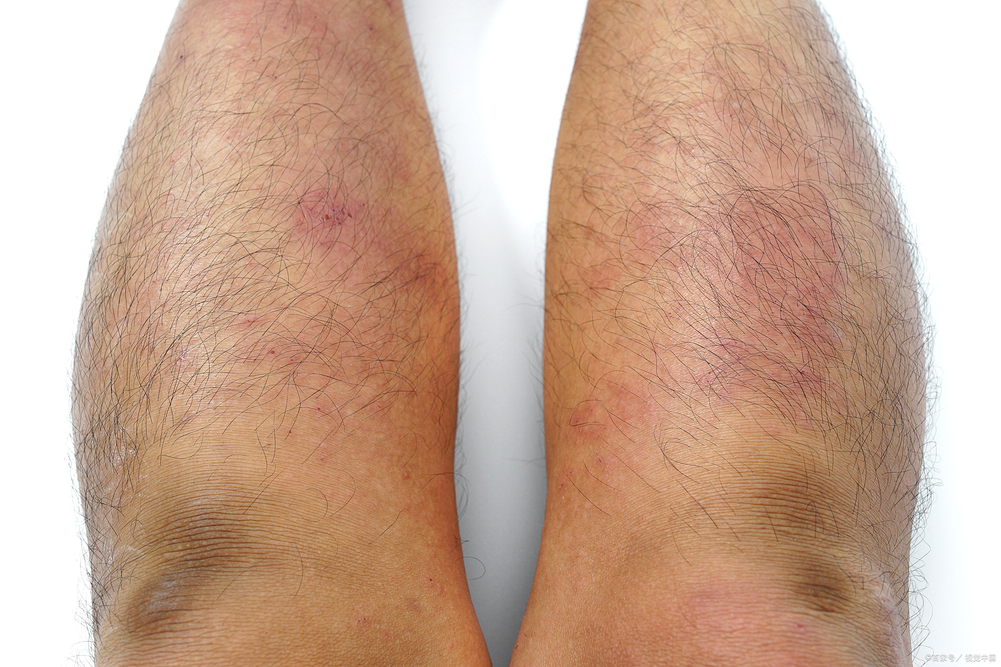 牛皮癣吃了中药后更严重咋回事,牛皮癣痒了怎么办