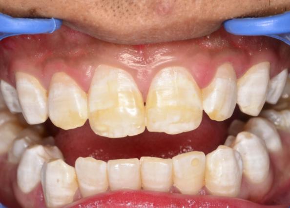 氟斑牙治疗的3种方法,氟斑牙最佳修复方法